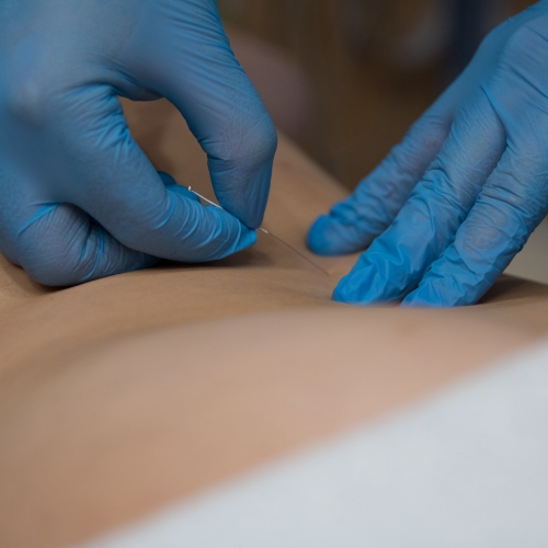 Dry needling treatment at Trinity Rehab