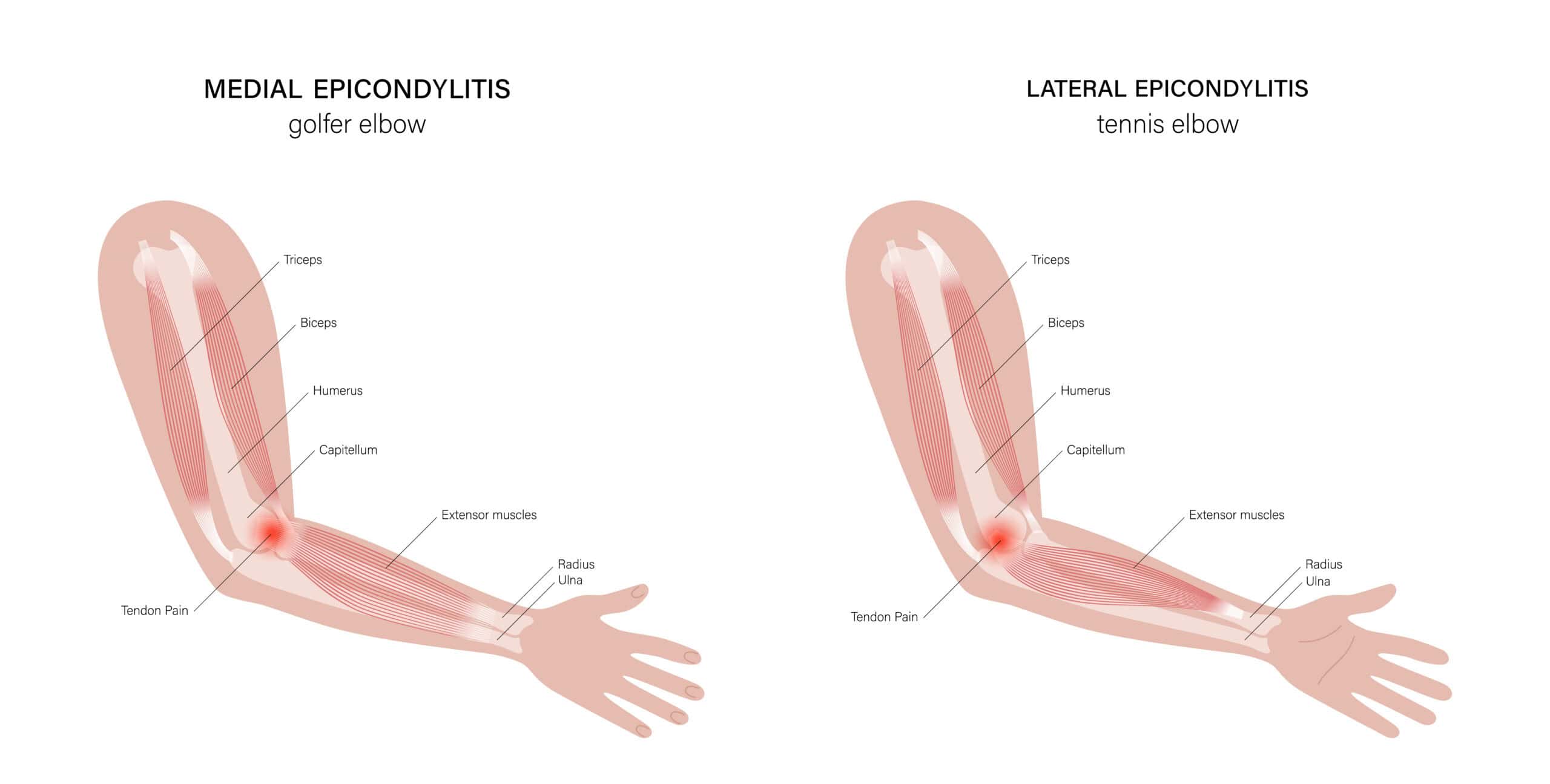 Golfer's elbow anatomy diagram showing lateral and medial epicondylitis