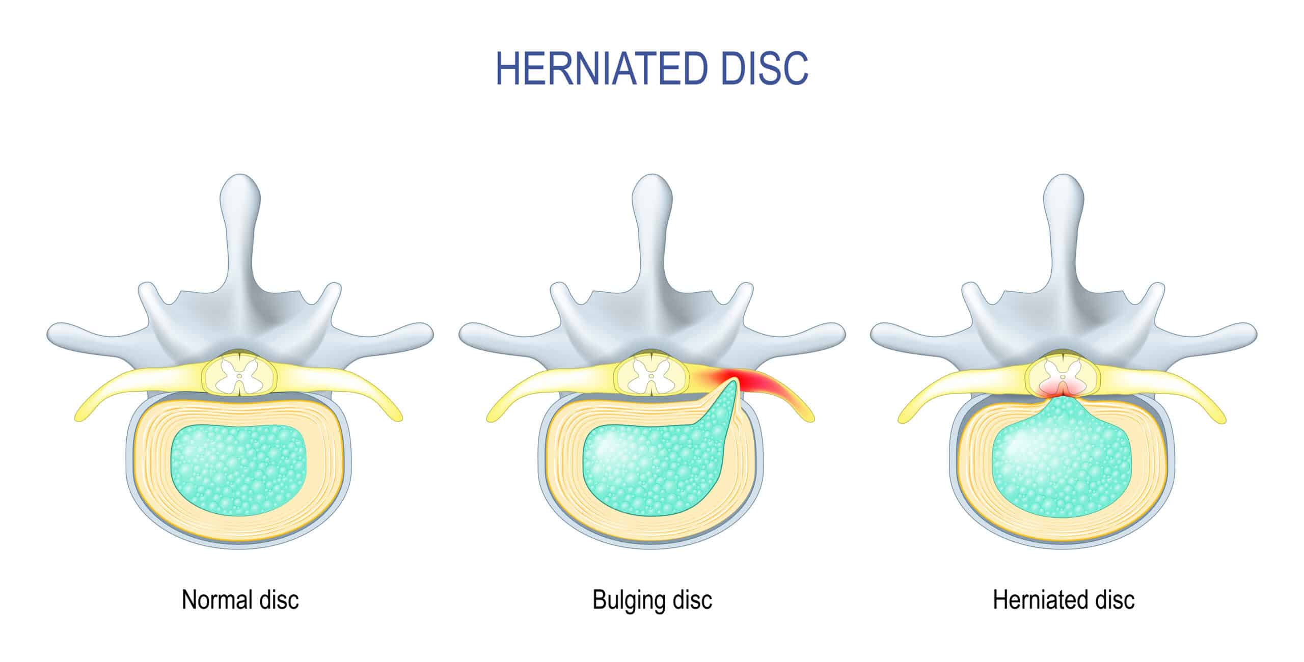 Lumbar spine anatomy showing disc herniation