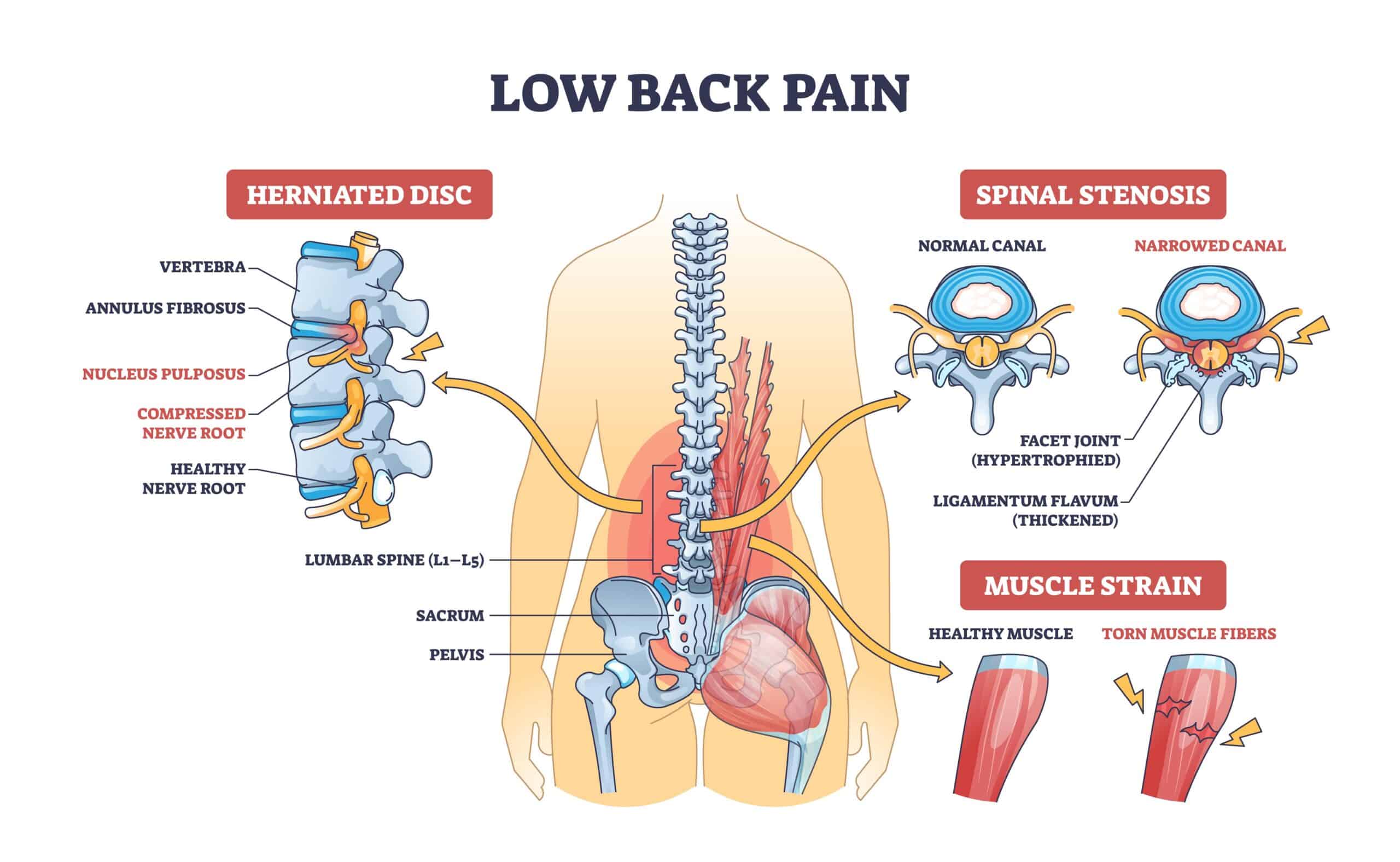 Medical illustration of lumbar spine anatomy for back pain treatment
