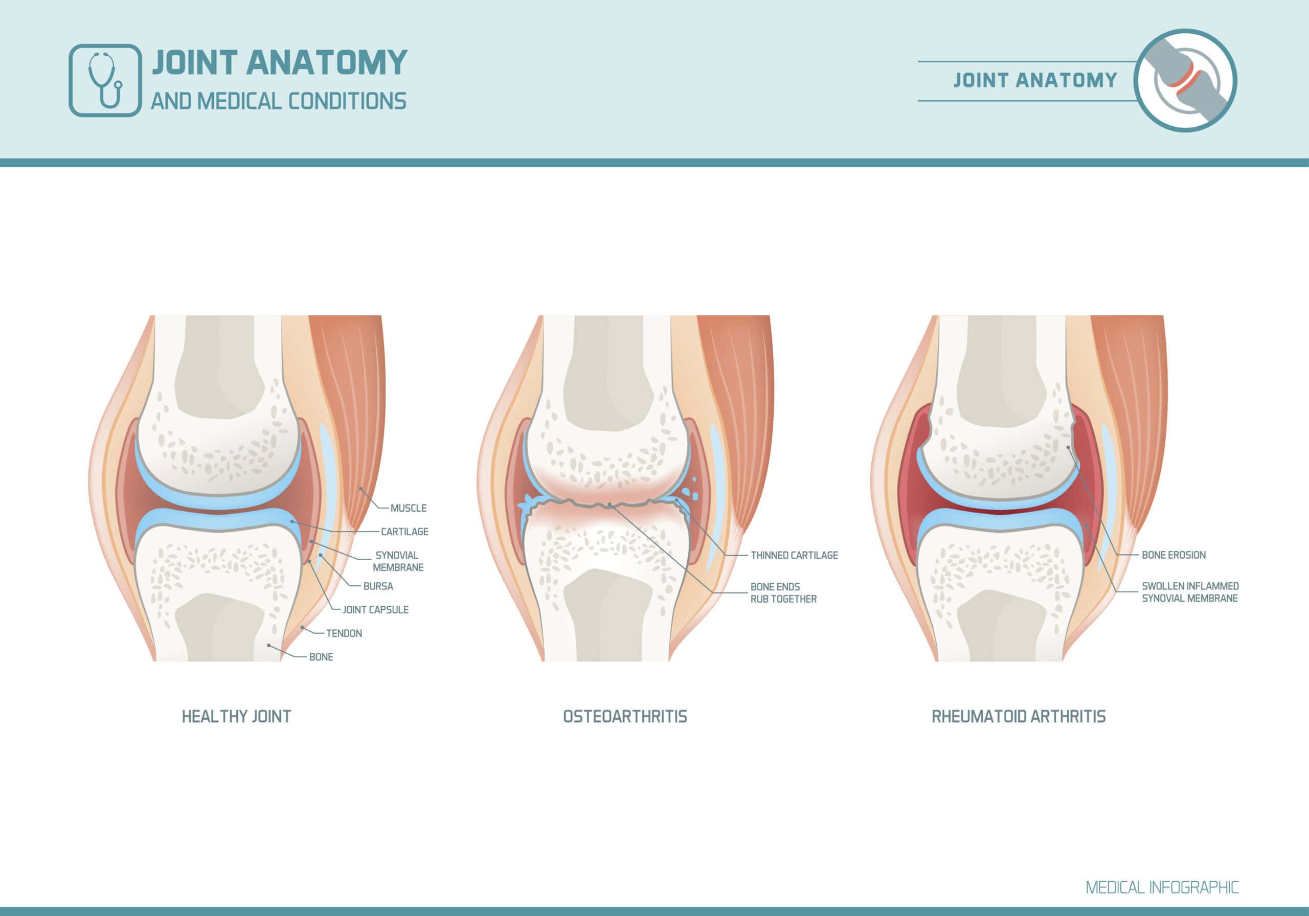 Osteoarthritis joint anatomy diagram showing cartilage degradation