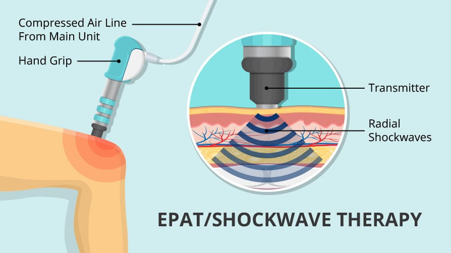 EPAT shockwave therapy applied to a patient's lower back