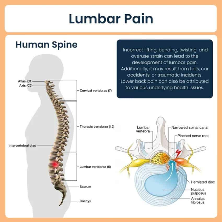 Lumbar spine anatomy showing a herniated disc