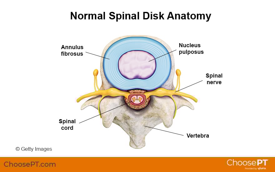 lumbar disc herniation anatomy diagram - medical illustration