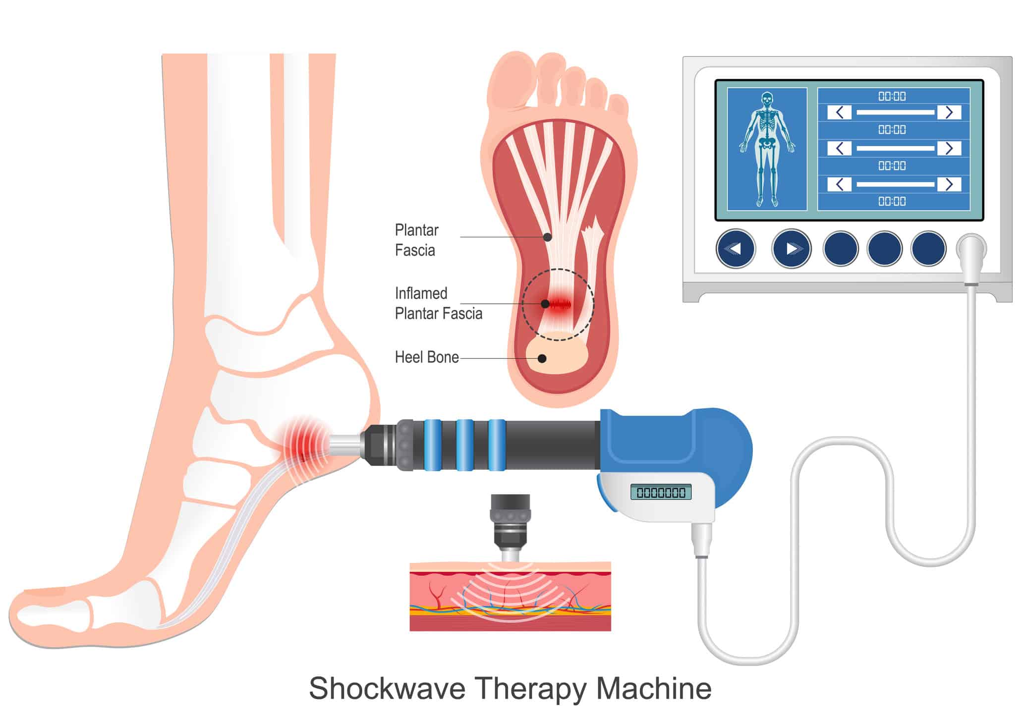 EPAT shockwave therapy treatment device used during physical therapy